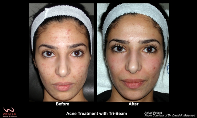 Acne | West LA Medical and Skincare : West LA Medical and Skincare