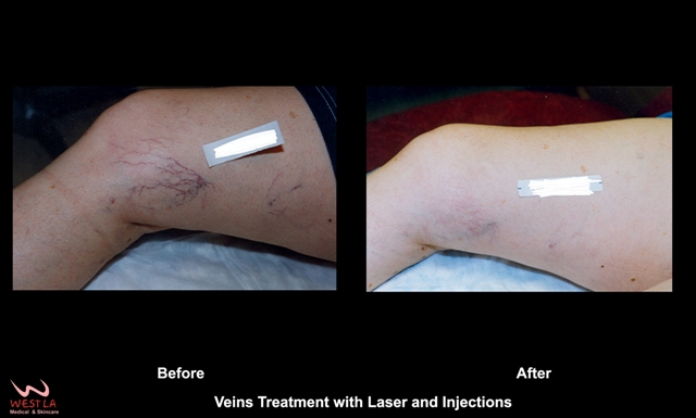 Effective Laser Treatments for Spider and Varicose Veins